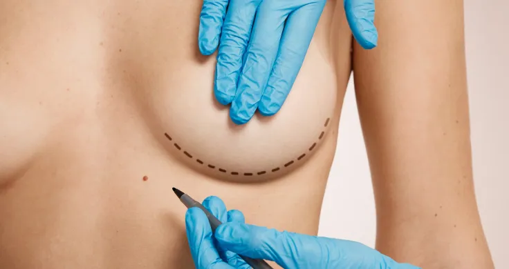 Breast Lift vs Breast Augmentation
